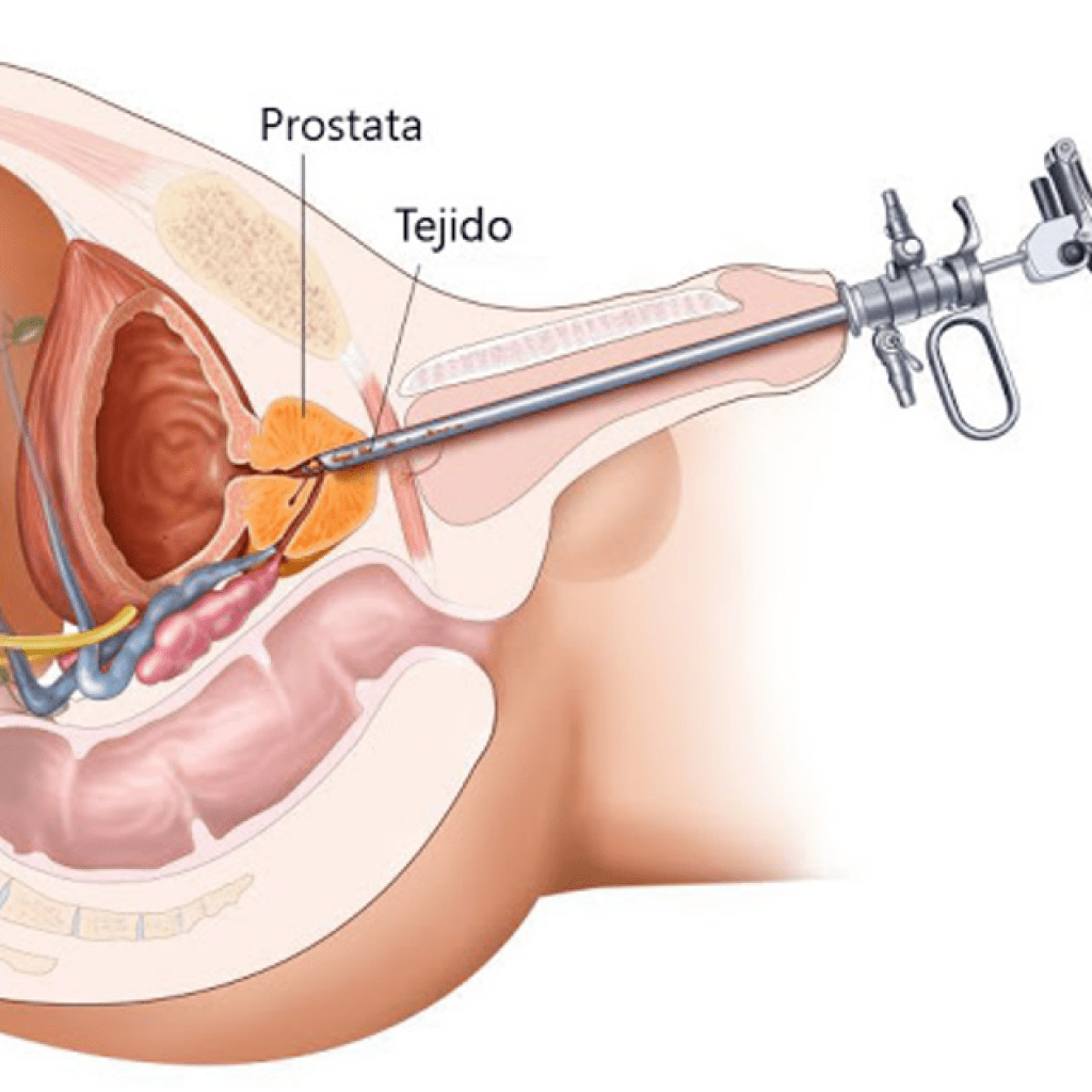 cirugia de prostata en guadalajara