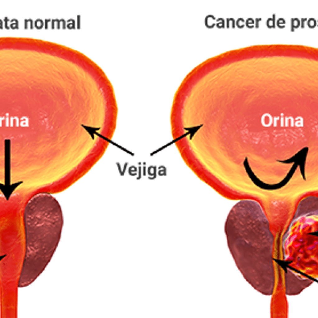 cirugia de prostata en guadalajara