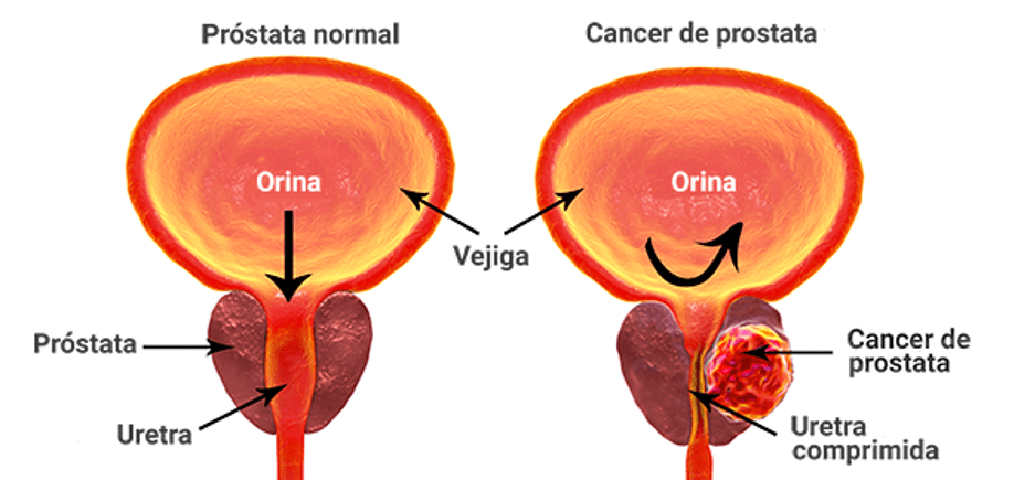 cirugia de prostata en guadalajara