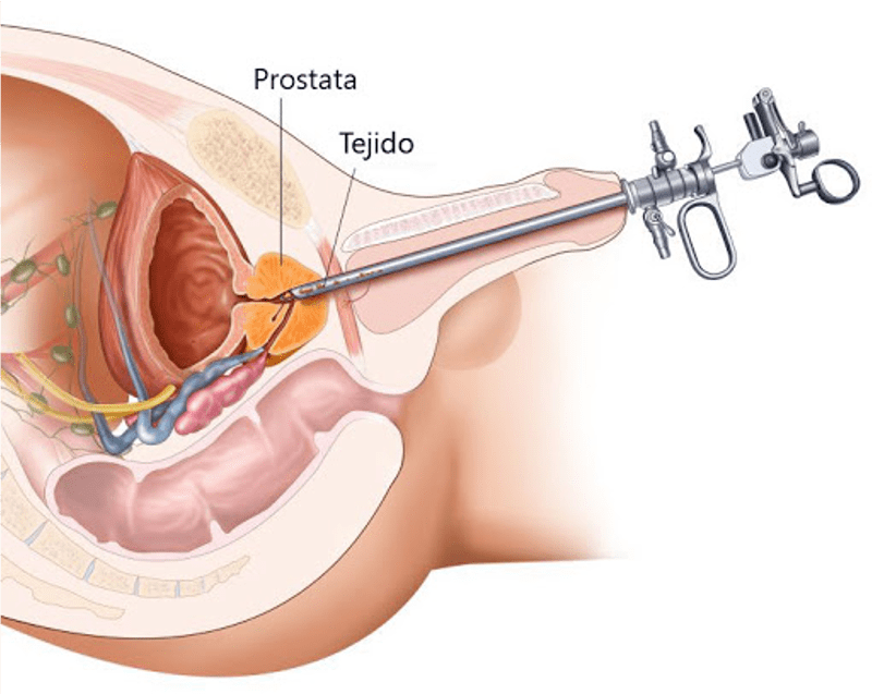 cirugia de prostata en guadalajara