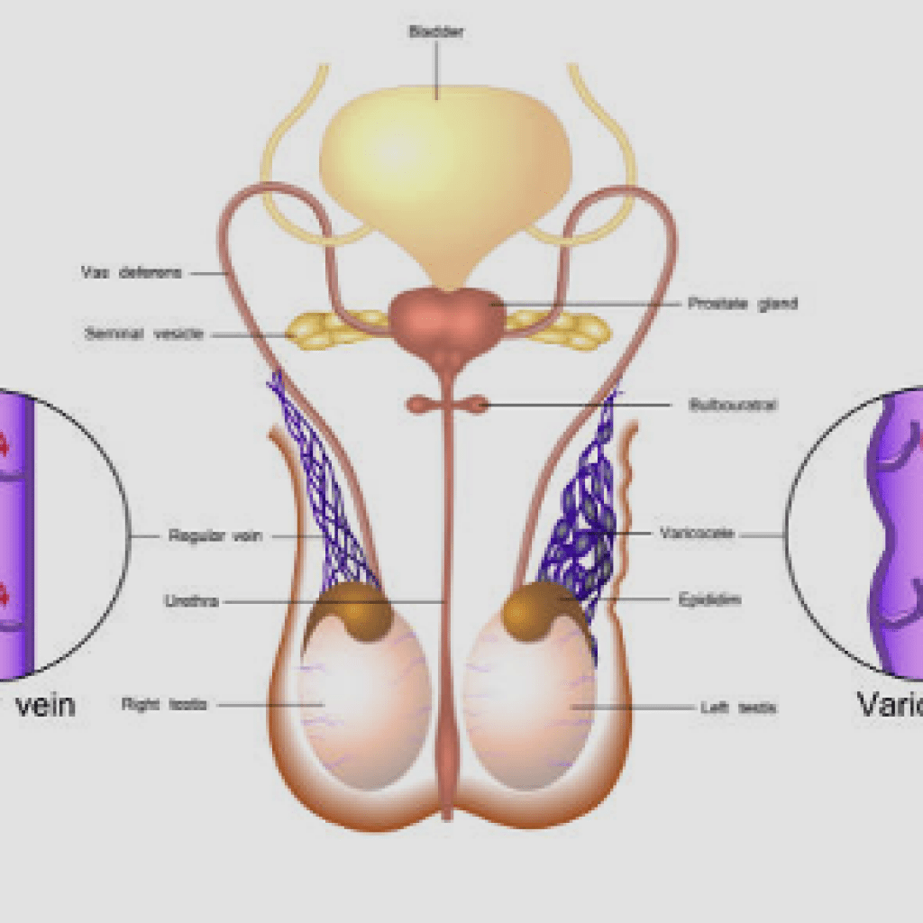 ¿Peculiaridades del varicocele?