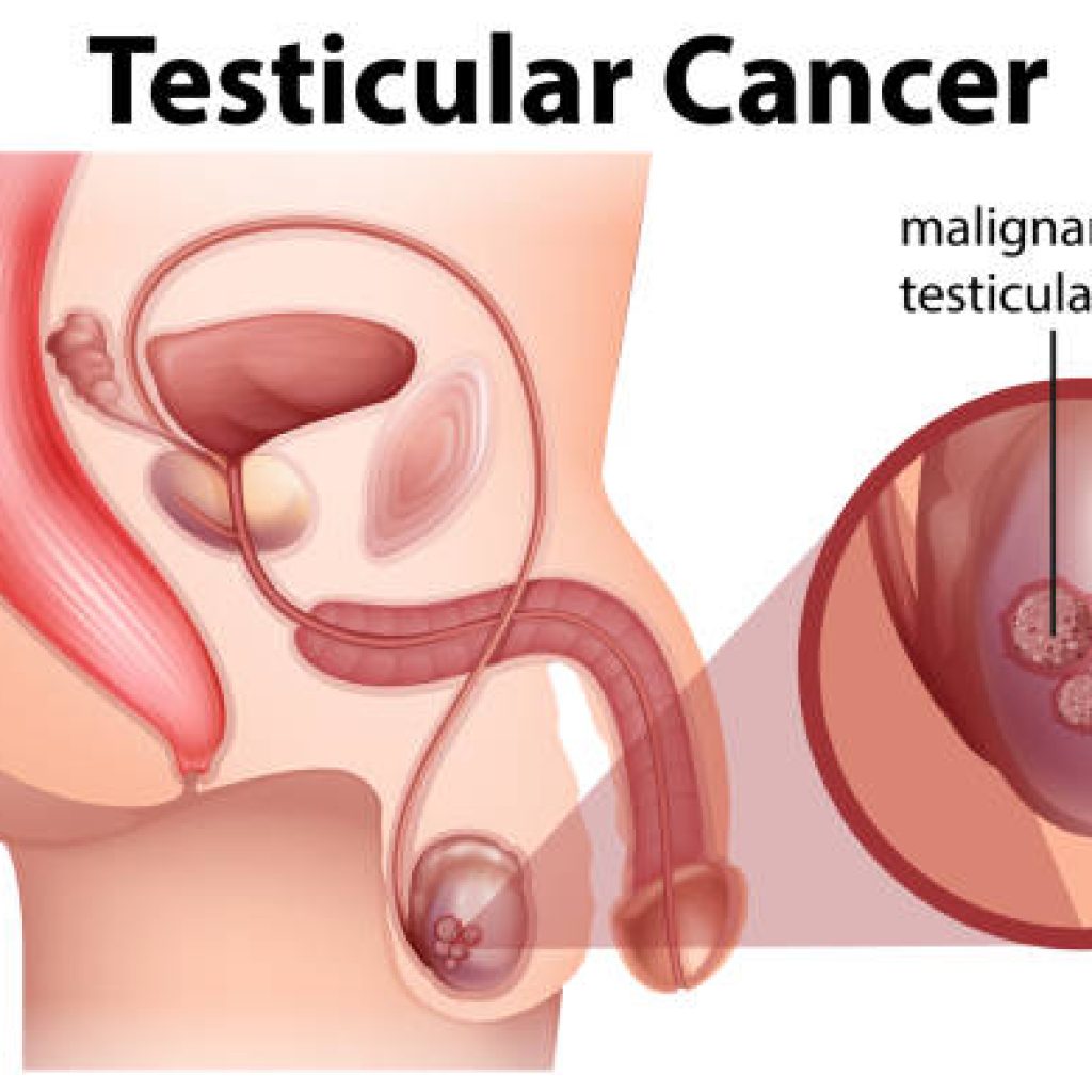 ¿Cómo saber si tengo cáncer testicular?