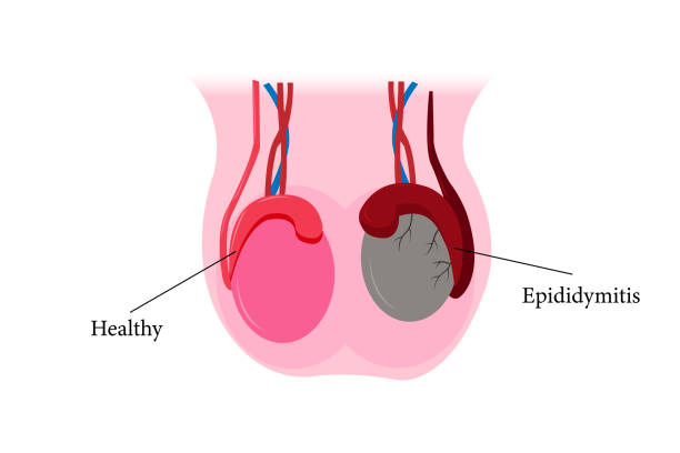 tumor testicular