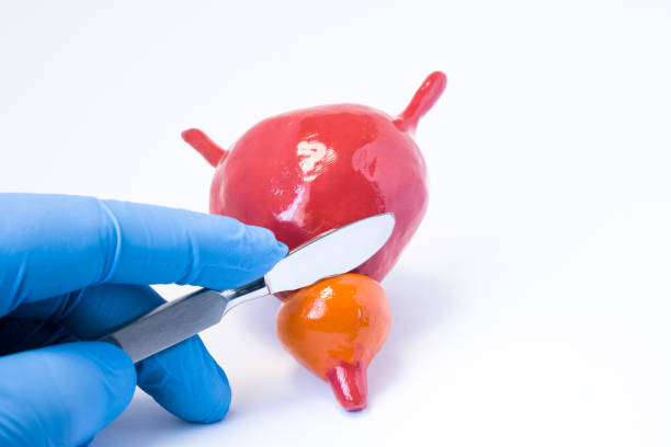 cirugía de próstata en Guadalajara