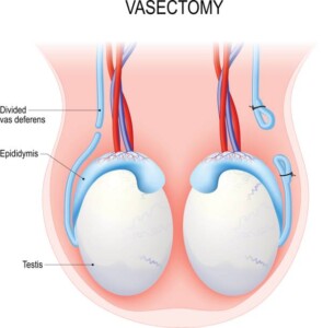 Vasectomía sin bisturí vs. tradicional: ¿cuál es la mejor opción?