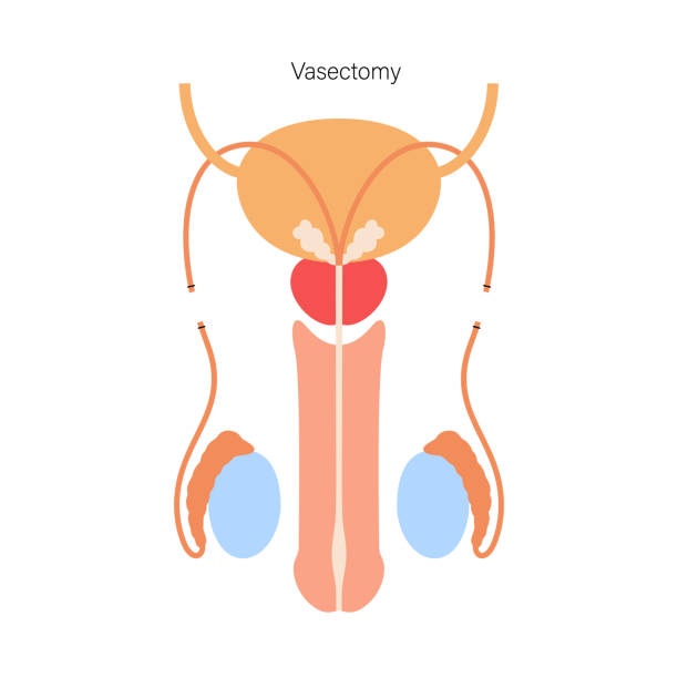 vasectomía sin bisturí en Guadalajara