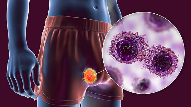 ¿Cómo diferencia el urólogo un tumor testicular benigno de una lesión maligna? ¿Cómo diferencia el urólogo un tumor testicular benigno de una lesión maligna?