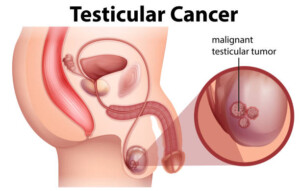 ¿Qué ocurre con el diagnóstico de un tumor testicular canceroso?
