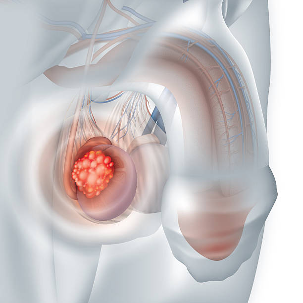 ¿Qué ocurre con el diagnóstico de un tumor testicular canceroso? ¿Qué ocurre con el diagnóstico de un tumor testicular canceroso?