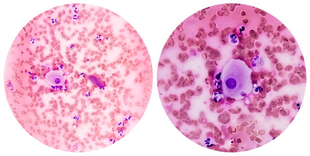 hematuria