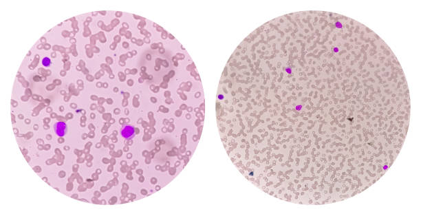 hematuria